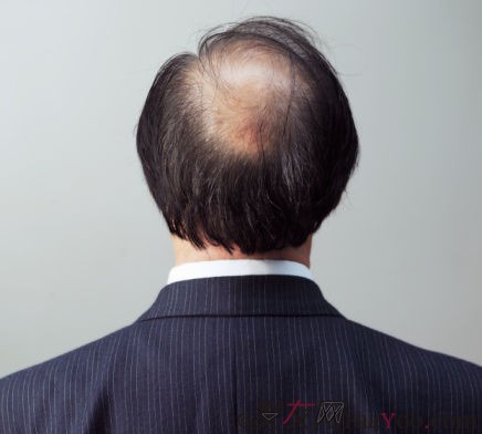 深圳脱发是由什么原因所导致