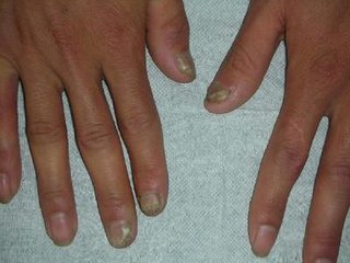 灰指甲治疗的误区